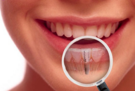 Dental Implants malta, dentist malta, dentistry malta, dental clinic malta, regional dental clinic malta