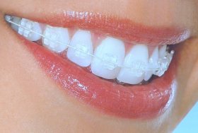 Orthodontics and Braces  malta, dentist malta, dentistry malta, dental clinic malta, regional dental clinic malta