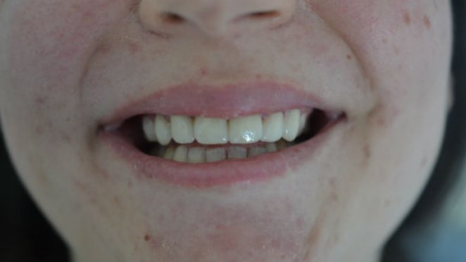 Six front teeth malta, dentist malta, dentistry malta, dental clinic malta, regional dental clinic malta