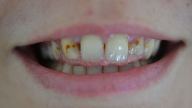 Six front teeth malta, dentist malta, dentistry malta, dental clinic malta, regional dental clinic malta