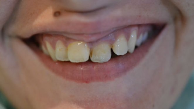 Combination of lip and dental treatment malta, dentist malta, dentistry malta, dental clinic malta, regional dental clinic malta