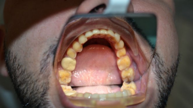 Stopping acid in its tracks malta, dentist malta, dentistry malta, dental clinic malta, regional dental clinic malta