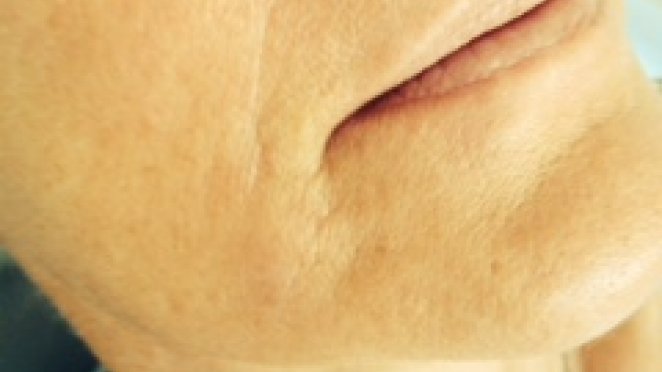 Softening of heavy folds and wrinkles  immediate result malta, dentist malta, dentistry malta, dental clinic malta, regional dental clinic malta