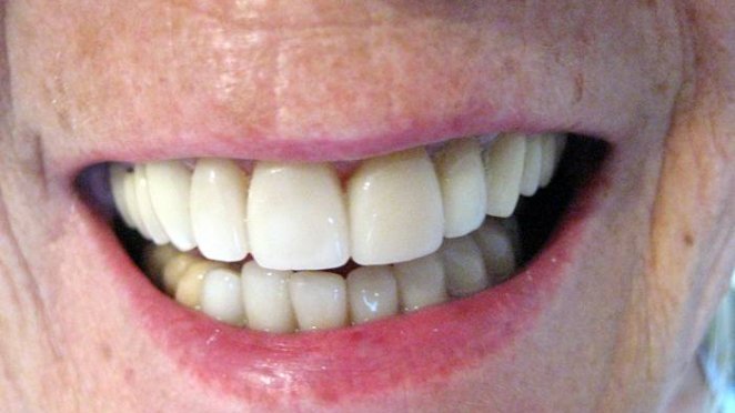 After malta, Porcelain veneers placed on upper and  lower teeth malta, dentist malta, dentistry malta, dental clinic malta, regional dental clinic malta