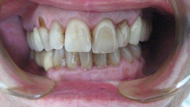 Before malta, Porcelain veneers placed on upper and  lower teeth malta, dentist malta, dentistry malta, dental clinic malta, regional dental clinic malta