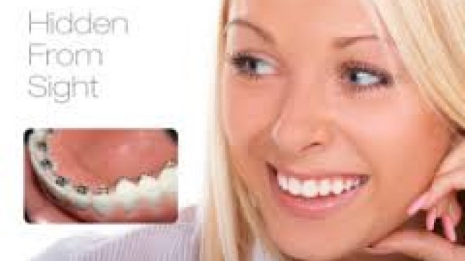 Lingual (Hidden) Braces malta, dentist malta, dentistry malta, dental clinic malta, regional dental clinic malta