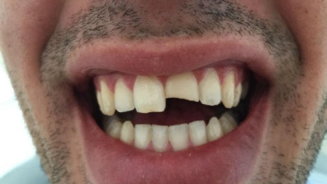 Cracked front tooth - repaired in 45 min malta, dentist malta, dentistry malta, dental clinic malta, regional dental clinic malta