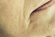 Softening of heavy folds and wrinkles  immediate result malta,    malta, dentist malta, dentistry malta, dental clinic malta, regional dental clinic malta