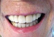 After malta, Porcelain veneers placed on upper and  lower teeth malta,    malta, dentist malta, dentistry malta, dental clinic malta, regional dental clinic malta