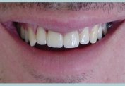Replacement of Old Front Multiple Restorations malta,    malta, dentist malta, dentistry malta, dental clinic malta, regional dental clinic malta
