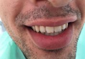 Cracked front tooth - repaired in 45 min malta,    malta, dentist malta, dentistry malta, dental clinic malta, regional dental clinic malta