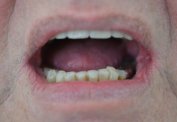 Severe wear on lower front teeth malta,    malta, dentist malta, dentistry malta, dental clinic malta, regional dental clinic malta